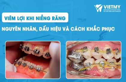 Viêm Lợi Khi Niềng Răng: Nguyên Nhân, Dấu Hiệu và Cách Khắc Phục